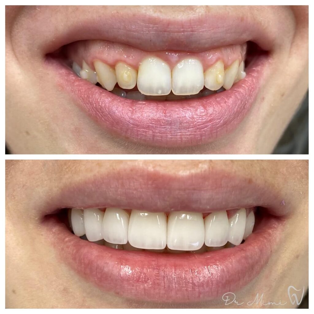 Gum Contouring in Arlington VA Before & After